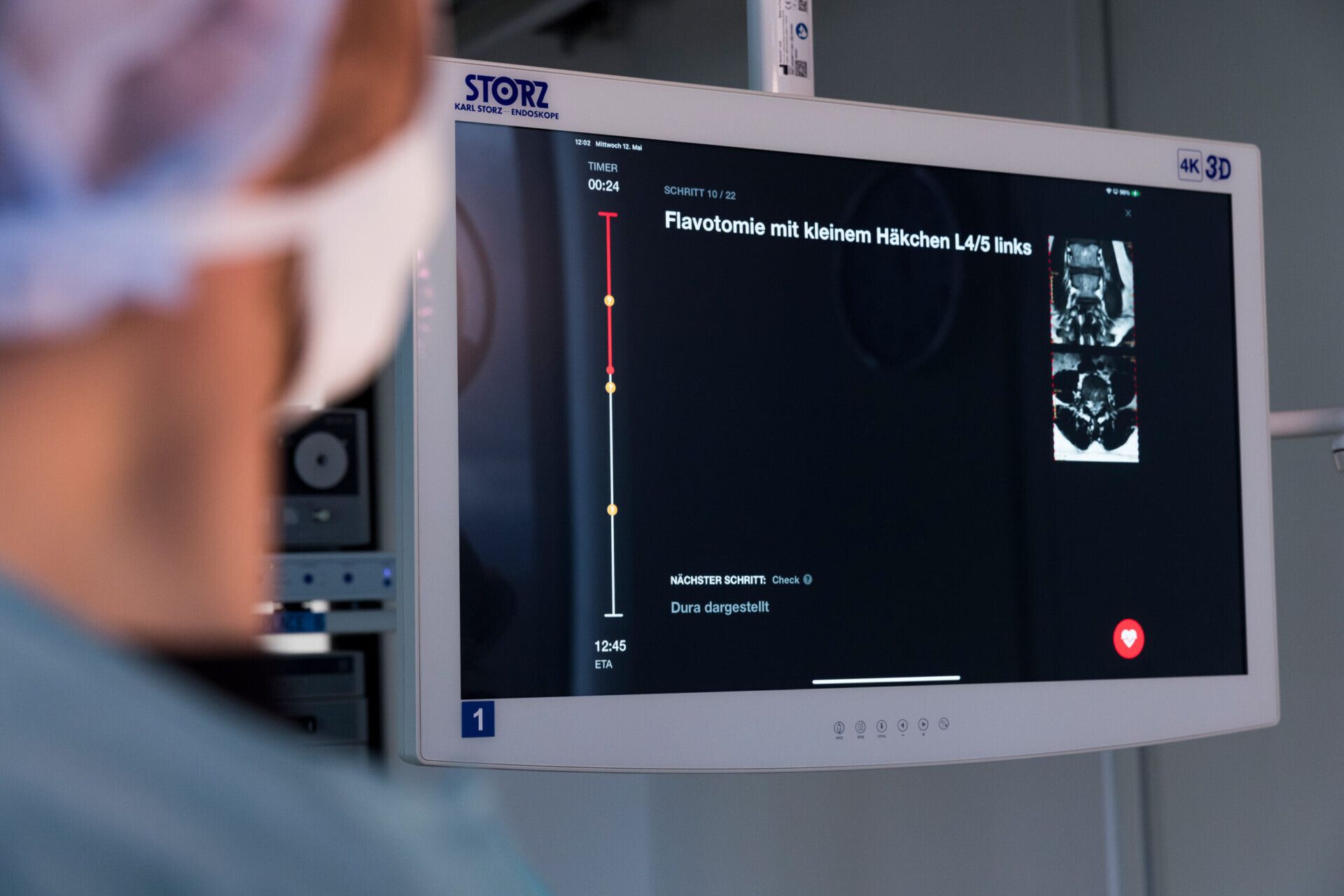 The IMPedia intra-operative view on a surgical monitor: a vertical step timeline with a live timer